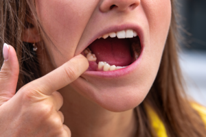 Missing tooth 1