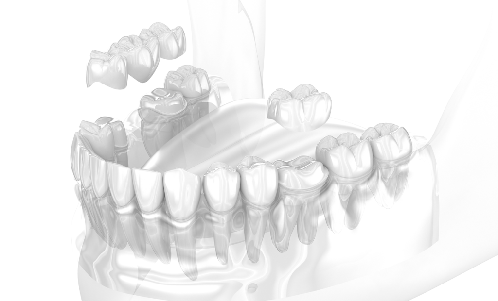 Dental crowns and briges naples dental boutique 1