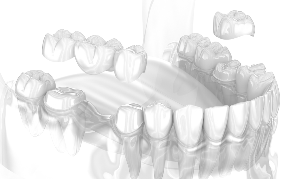 Dental crowns and briges naples dental boutique 2