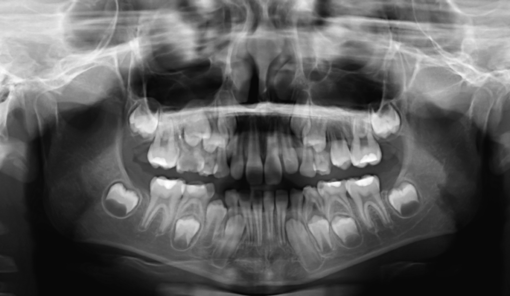 Oral cancer screenings naples dental boutique 3