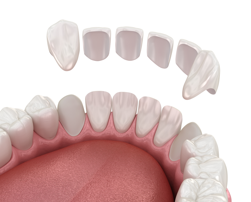 Porcelain veneers naples dental boutique 1