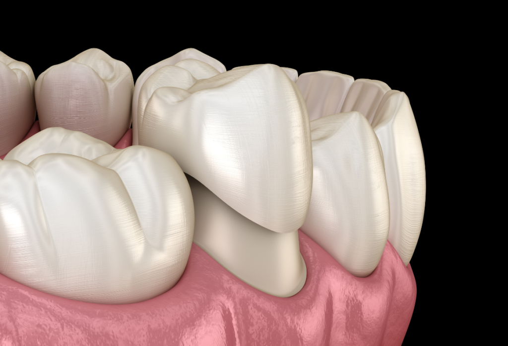 Same day crowns naples dental boutique