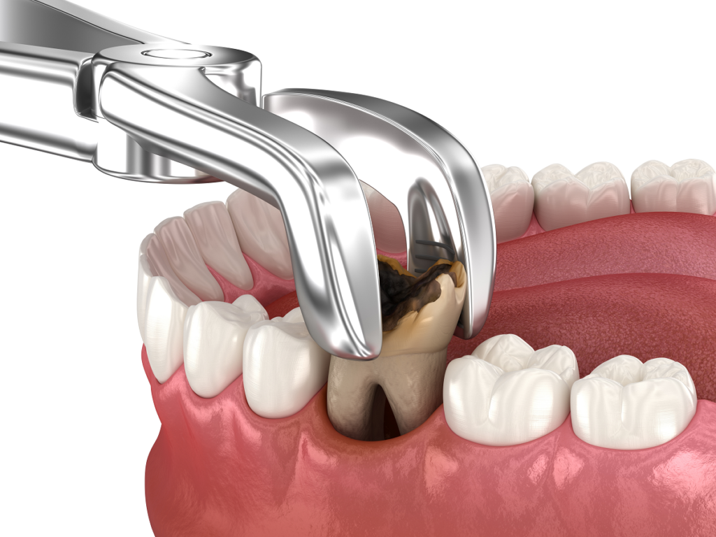 Tooth extractions naples dental boutique 1