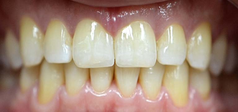 3 after