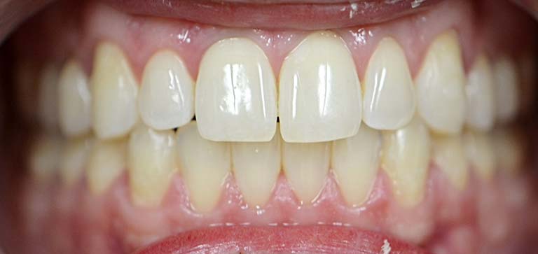 5 after