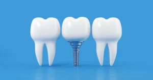 3d illustration of a dental implant placed between two natural teeth, showcasing a titanium screw base and artificial crown on a blue background.