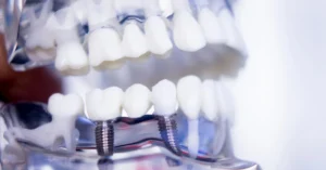Close-up of a dental model showing titanium dental implants supporting artificial teeth, used to demonstrate implant-supported restoration procedures.