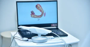 Intraoral scanner connected to a laptop displaying a 3d digital dental model at a high-tech dental clinic in naples, fl.