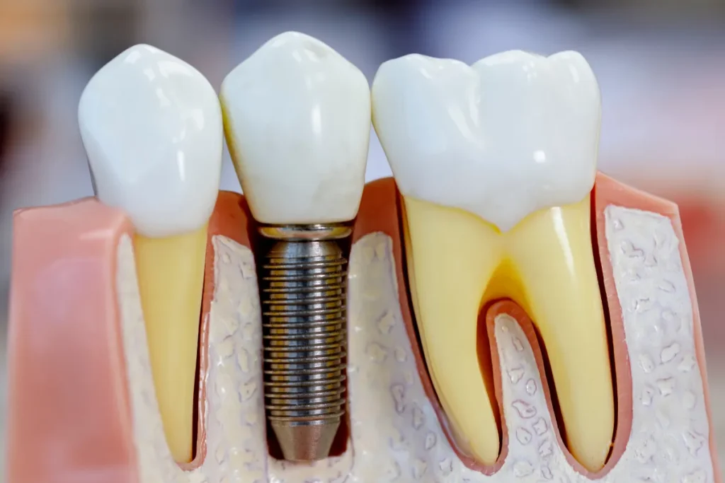 Dental implant ndg 3